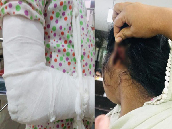 താമരശ്ശേരിയില്‍ സ്രീധനത്തിന്റെ പേരില്‍ യുവതിയ്ക്ക് ഭര്‍ത്താവിന്റെ ക്രൂരമര്‍ദ്ദനം;ചെവി കടിച്ചു മുറിച്ചു,മകളെ ചൂടുവെള്ളമൊഴിച്ചു പൊള്ളേല്‍പ്പിച്ചു