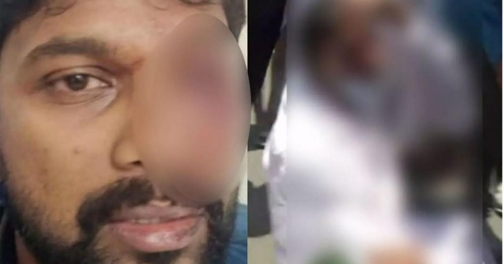 പ്രതിഷേധ മാര്‍ച്ചിനിടെയുണ്ടായ ലാത്തിചാര്‍ജില്‍ പരുക്കേറ്റ യൂത്ത് കോണ്‍ഗ്രസ് നേതാവിന്റെ കണ്ണിന്റെ കാഴ്ച്ചശക്തി നഷ്ടമായി.