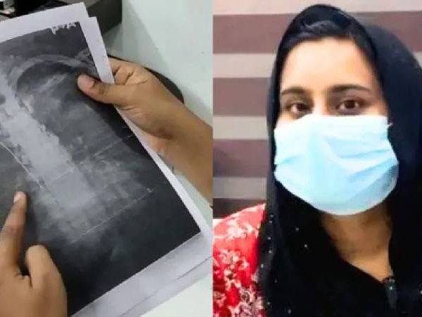 ശസ്ത്രക്രിയയെ തുടർന്ന് ഗൈഡ് വയർ നെഞ്ചിൽ കുടുങ്ങി:നഷ്ടപരിഹാരം തേടി സുമയ്യ കോടതിയിലേക്ക്